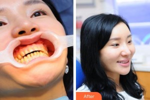 咸寧市第一人民醫(yī)院口腔科鎮(zhèn)榮軍整形價(jià)格表附金屬托槽矯正案例展示