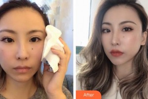 孝感仁愛(ài)醫(yī)院美容整形中心金日炫整形價(jià)格表附埋線提升案例展示