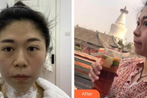 孝感歐陽整形美容診所王珺整形價(jià)格表附熱瑪吉案例展示