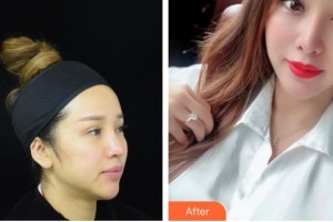 孝感天妃醫(yī)療美容門(mén)診部吳紀(jì)園整形價(jià)格表附射頻緊膚例展示