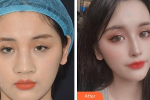 孝感愛(ài)爾眼科醫(yī)院魏淑明整形價(jià)格表附眼部綜合案例展示