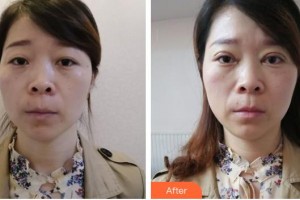 孝感愛(ài)爾眼科醫(yī)院葉剛整形價(jià)格表附切開(kāi)雙眼皮案例展示