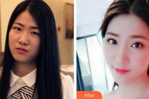 孝感愛(ài)爾眼科醫(yī)院李勇整形價(jià)格表附切開(kāi)雙眼皮案例展示