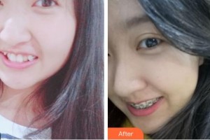 孝感城中口腔門(mén)診楊雷整形價(jià)格表附金屬托槽矯正案例展示