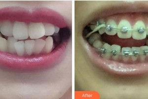 孝感健吉口腔門(mén)診部程德新整形價(jià)格表附金屬托槽矯正案例展示