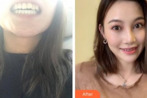 孝感植貝爾口腔門診部王悟君整形價(jià)格表附牙齒隱形矯正案例展示