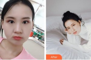 鄂州逆時(shí)光醫(yī)療美容醫(yī)院李利整形價(jià)格表附熱瑪吉案例展示