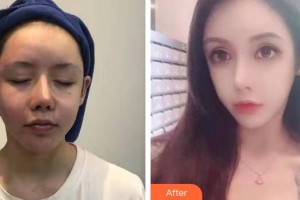 鄂州逆時(shí)光醫(yī)療美容醫(yī)院鄧小曼整形價(jià)格表附熱瑪吉案例展示