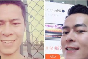 鄂州中山口腔醫(yī)院徐榮建整形價(jià)格表附金屬托槽矯正案例展示