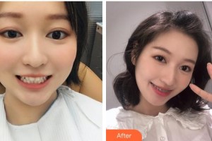 鄂州中山口腔醫(yī)院徐甜整形價(jià)格表附金屬托槽矯正案例展示