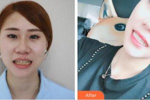 鄂州中山口腔醫(yī)院梁智整形價(jià)格表附美白劑美白牙齒案例展示