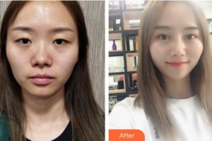 鄂州愛爾眼科醫(yī)院葉波整形價(jià)格表附切開雙眼皮案例展示