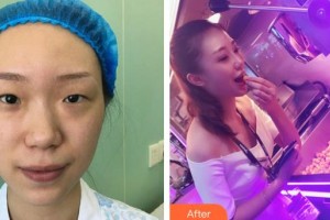 武漢兒童醫(yī)院李世蓮整形價(jià)格表附切開雙眼皮案例展示