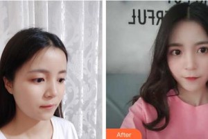 武漢兒童醫(yī)院葉嬰茀整形價(jià)格表附開內(nèi)眼角案例展示