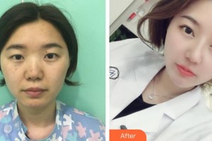 武漢兒童醫(yī)院揭紅整形價(jià)格表附眼部綜合案例展示