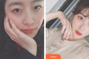 武漢艾格眼科醫(yī)院彭華琮整形價(jià)格表附眼部綜合案例展示