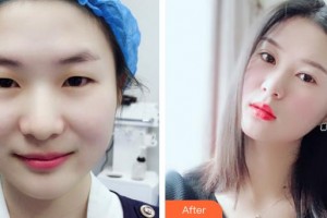 武漢艾格眼科醫(yī)院程勉征整形價(jià)格表附眼部綜合案例展示