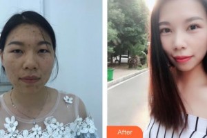 武漢艾格眼科醫(yī)院周雄整形價(jià)格表附切開雙眼皮案例展示