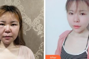 武漢艾格眼科醫(yī)院陳雅瓊整形價(jià)格表附切開雙眼皮案例展示