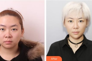 武漢艾格眼科醫(yī)院彭志華整形價(jià)格表附切開雙眼皮案例展示