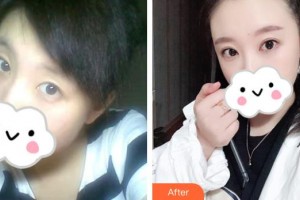 武漢艾格眼科醫(yī)院樓永倞整形價(jià)格表附外切祛眼袋案例展示