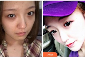 武漢艾格眼科醫(yī)院劉新榮整形價(jià)格表附開外眼角案例展示