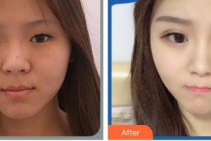 武漢艾格眼科醫(yī)院吳嵐整形價(jià)格表附埋線雙眼皮案例展示