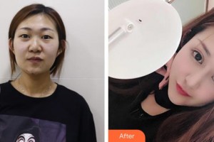 武漢艾格眼科醫(yī)院董艷霞整形價(jià)格表附切開雙眼皮案例展示