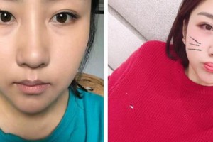 武漢艾格眼科醫(yī)院許澤駿整形價(jià)格表附眼部綜合案例展示