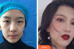 武漢艾格眼科醫(yī)院金中秋整形價(jià)格表附切開雙眼皮案例展示