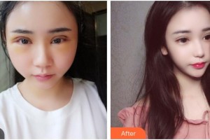 武漢艾格眼科醫(yī)院楊蕾整形價格表附切開雙眼皮案例展示