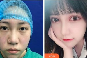 武漢艾格眼科醫(yī)院袁媛整形價格表附切開雙眼皮案例展示