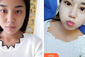 武漢艾格眼科醫(yī)院沈錦霞整形價格表附眼部綜合案例展示