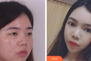 武漢艾格眼科醫(yī)院高金濤整形價格表附眼部綜合案例展示