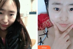 武漢艾格眼科醫(yī)院黃鵬程整形價格表附眼部綜合案例展示