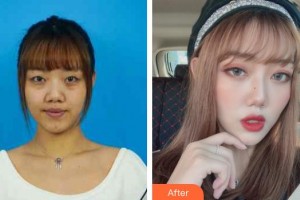 武漢艾格眼科醫(yī)院林玲整形價格表附內(nèi)切祛眼袋案例展示