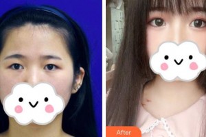 武漢艾格眼科醫(yī)院劉宗萬整形價格表附眼部綜合案例展示