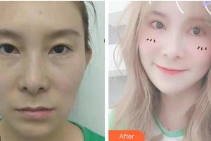 武漢艾格眼科醫(yī)院徐漢文整形價格表附眼部綜合案例展示