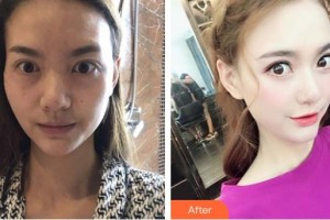 武漢艾格眼科醫(yī)院熊鳳珠整形價格表附眼部修復(fù)案例展示