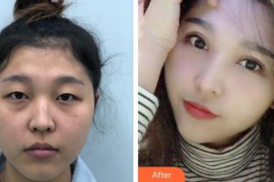 武漢艾格眼科醫(yī)院劉志光整形價格表附眼部綜合案例展示