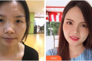 武漢艾格眼科醫(yī)院伍清香整形價格表附切開雙眼皮案例展示