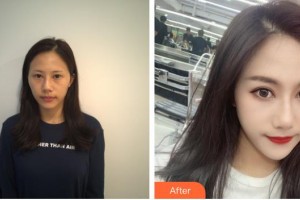 武漢艾格眼科醫(yī)院洪利整形價格表附眼部修復(fù)案例展示