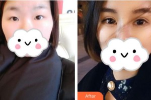 武漢艾格眼科醫(yī)院李愛民整形價格表附眼部綜合案例展示