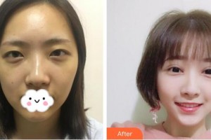 武漢艾格眼科醫(yī)院胡曉兵整形價(jià)格表附切開(kāi)雙眼皮案例展示