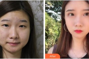 武漢艾格眼科醫(yī)院張?jiān)接⒄蝺r(jià)格表附切開(kāi)雙眼皮案例展示