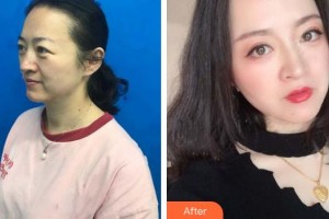 武漢艾格眼科醫(yī)院鄢俊杰整形價格表附切眉術(shù)案例展示