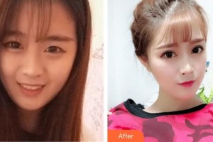 武漢艾格眼科醫(yī)院高天整形價(jià)格表附切開(kāi)雙眼皮案例展示