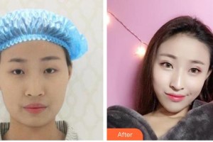 武漢佰視達(dá)眼科門診部鄭兩定整形價格表附切開雙眼皮案例展示