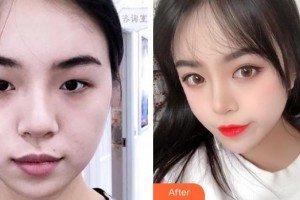 武漢艾格眼科醫(yī)院薩米爾整形價格表附開內(nèi)眼角案例展示