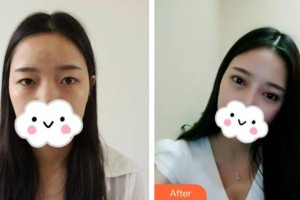 武漢艾格眼科醫(yī)院雷澄整形價(jià)格表附眼部綜合案例展示